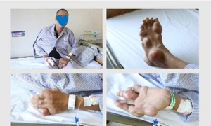 Chủ quan không điều trị bệnh Gout, người đàn ông bị biến dạng tay chân