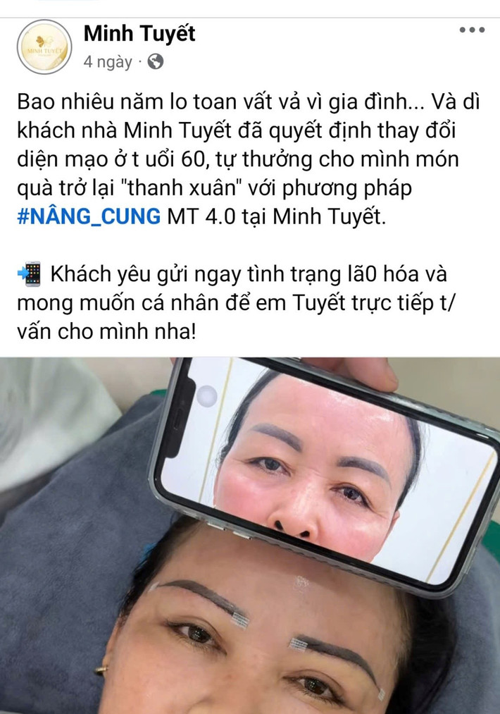 Cũng như dịch vụ nâng cung chân mày, nhưng cơ sở Minh Tuyết vẫn ngang nhiên quảng cáo, triển khai dịch vụ này