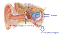 Tại sao bác sĩ khám Tai Mũi Họng lại chỉ định đo thính lực - nhĩ lượng?