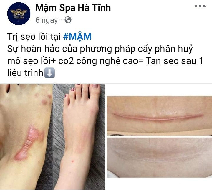 Quảng cáo điều trị sẹo lồi tại cơ sở Mậm Spa