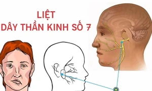 Bác sĩ cảnh báo tắm đêm dẫn tới nguy cơ liệt dây thần kinh số 7