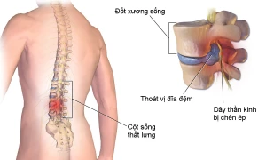 Nguyên nhân gây thoát vị đĩa đệm cột sống thắt lưng và cách chuẩn đoán bệnh