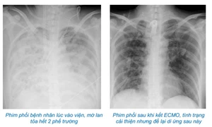 Tự điều trị cúm, bệnh nhân phải chạy ECMO 37 ngày do viêm phổi bội nhiễm