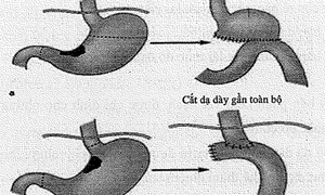 Nguyên nhân dẫn đến ung thư dạ dày