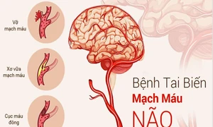 Cảnh báo nguy cơ tai biến mạch máu não ở người trẻ