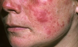 Những biến chứng thường gặp của bệnh lupus ban đỏ