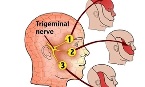 Đau nửa mặt là triệu chứng của bệnh đau dây thần kinh số V