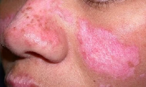 Cảnh báo bệnh Lupus ban đỏ hệ thống: Hàng trăm nghìn người mắc mỗi năm