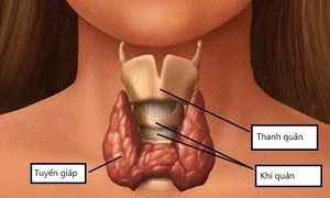 Bệnh cường giáp ở trẻ em: Hiếm gặp và rất nguy hiểm