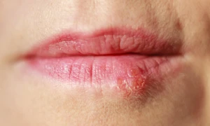 "Săn" mỹ phẩm secondhand trên mạng về dùng, cô gái trẻ viêm da kích ứng, nhiễm herpes môi