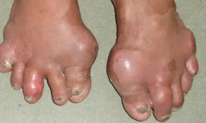 Vì sao bệnh gout có di truyền?