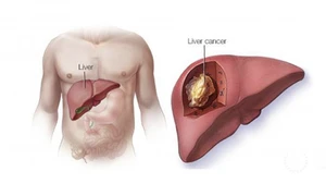 Chán ăn, chướng bụng, mệt mỏi… dấu hiệu cảnh báo ung thư gan