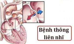 Những dấu hiệu nhận biết sớm về bệnh thông liên nhĩ