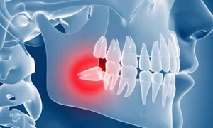 Vì sao cần phải nhổ răng khôn?