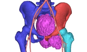 Tê bì vùng xương chậu, bệnh nhân 19 tuổi phát hiện mắc ung thư xương khổng lồ hiếm gặp