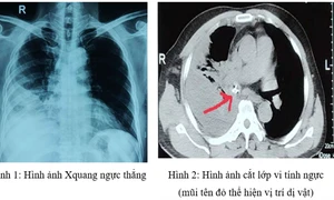 Cảnh báo nguy hiểm từ tình trạng sặc dị vật khi ăn