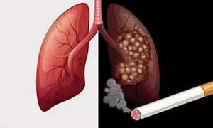 Người thường xuyên hút thuốc lá cần cảnh giác bệnh lý nguy hiểm gây suy hô hấp này