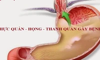 Cách phát hiện và xử lý viêm thanh quản trào ngược