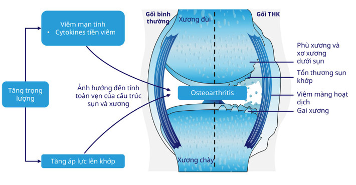 Ảnh hưởng của cân nặng lên khớp gối nếu người bệnh thừa cân, béo phì 1.png