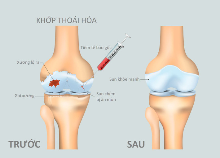 Tế bào gốc giúp làm đầy mặt sụn bị thoái hóa 2.jpg