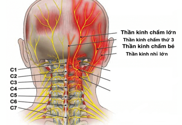Đã có phương pháp điều trị dứt điểm cơn đau dây thần kinh chẩm (Ảnh: BVCC) dau-day-than-kinh-cham-1-600x413.png -0