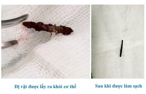 Chiếc đinh được lấy ra trong tình trạng rỉ sét (Ảnh: BVCC) Người đàn ông bất ngờ phát hiện chiếc đinh cắm sâu vào vùng cổ sau 15 năm -0