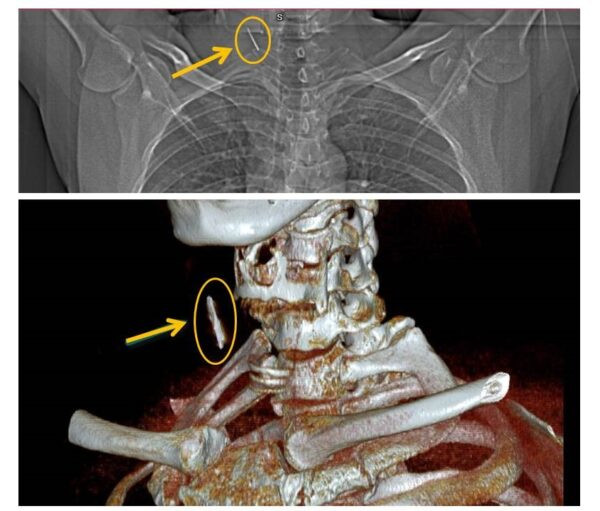 Hình ảnh dị vật trên phim chụp CT cắt lớp vi tính có dựng hình (Ảnh: BVCC) Người đàn ông bất ngờ phát hiện chiếc đinh cắm sâu vào vùng cổ sau 15 năm -0
