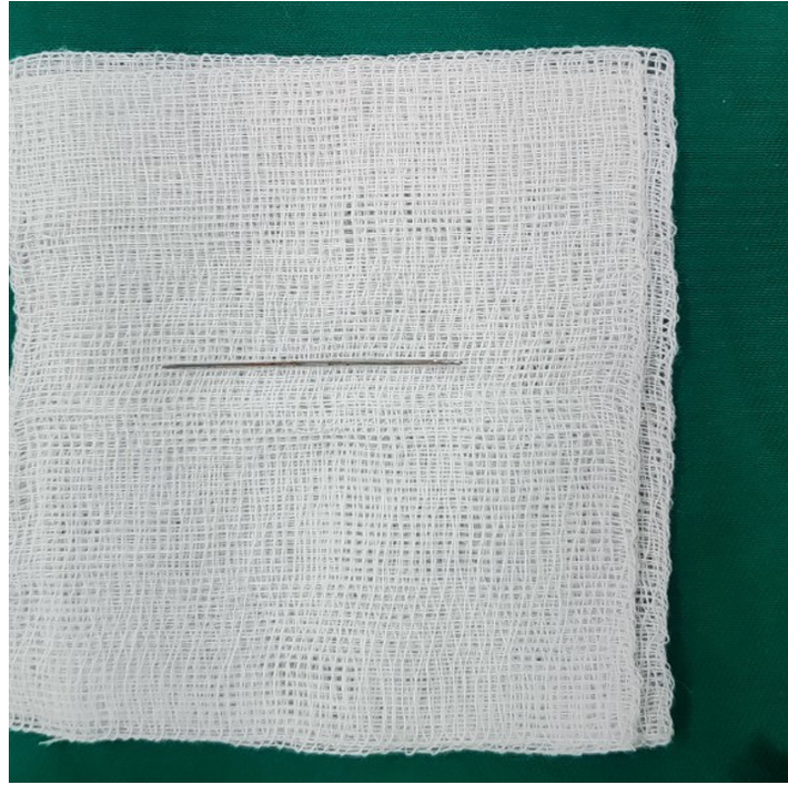 Hình ảnh chiếc kim 5cm sau khi được lấy ra khỏi mông của người bệnh Cô dâu bị kim đâm xuyên người ngay trong ngày cưới -0