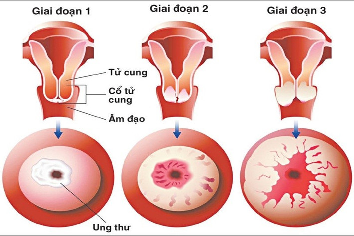 Ung thư cổ tử cung thường không rõ triệu chứng, tiến triển chậm khiến người bệnh chủ quan – Hình minh họa Dấu hiệu ung thư cổ tử cung và Phương pháp phòng ngừa bệnh -0