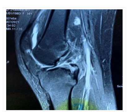 Chấn thương đứt dây chằng chéo sau trên phim MRI Bác sĩ cảnh báo khi nghe tiếng