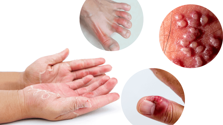 Bệnh cước tay chân thường xảy ra ở những vị trí trên cơ thể tiếp xúc trực tiếp với nhiệt độ lạnh (Ảnh minh họa) Nguyên nhân nào gây nên bệnh cước tay chân -0