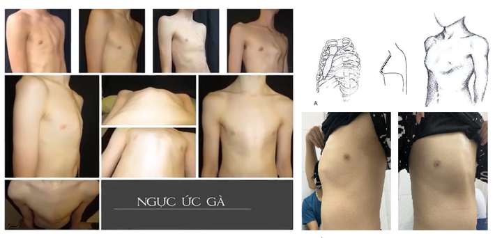 Nguyên nhân dẫn đến bệnh lý lồi ngực bẩm sinh – ngực ức gà ảnh 3 ngực-ức-gà-3.png -0