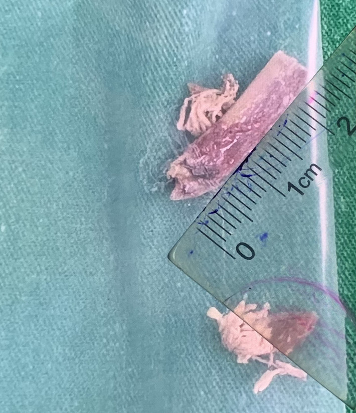 Dị vật gắp ra từ thực quản bệnh nhân là mảnh xương gà dài 2,5cm (Ảnh: BVCC) di_vat_0_0 (1).jpg -0