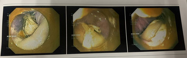 Hình ảnh nội soi xương gà trong thực quản bệnh nhân (Ảnh: BVCC) ns_0 (1).jpg -0