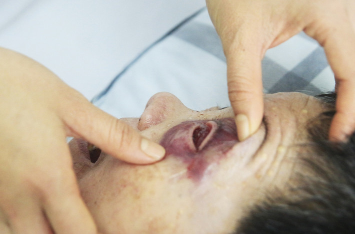 Bệnh nhân bị vỡ nhãn cầu mắt (Ảnh: BVCC) Không may bị ngã, người đàn ông 64 tuổi vỡ nhãn cầu -0