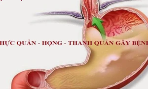 Cách phát hiện và xử lý viêm thanh quản trào ngược